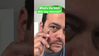 Best Skin Tag Removal At Home #shorts
