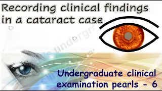 Recording clinical findings in a cataract case | Undergraduate clinical examination pearls - 6