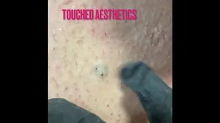 Episode 2 ingrown hair extractions