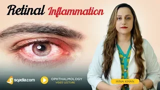 Retinal Inflammation | Clinical Ophthalmology Video | V-Learning | sqadia.com