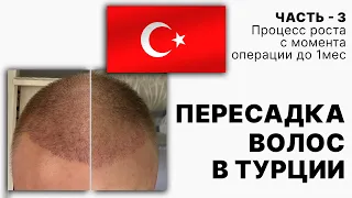 Пересадка волос в Турции. Часть-3 (процесс роста волос с начала  операции до 1мес)