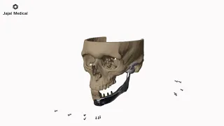 TMJ reconstruction using patient-specific Implant