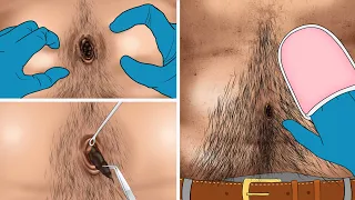 ASMR Animation Remove Navel Stone Animation | WOW Brain Deep Cleaning | Super Satisfying video