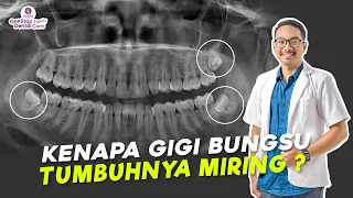 KENAPA GIGI BUNGSU TUMBUHNYA MIRING ? EFEK JIKA GIGI BUNGSU IMPAKSI TIDAK DICABUT ?