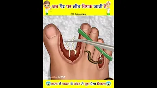 जब पैर पर लीच चिकप जाती है तो क्या होता है ||😱😱|| Amazing facts || #shorts