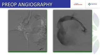 Bilateral Partial Anomalous Pulmonary Venous Connection