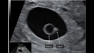 Ultrasound 6 Weeks Gestation |Early pregnancy scan |