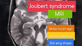 Joubert's syndrome! rare finding! #mri #joubert  #presentation #rare #radiologyresident  #radiology