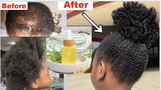 Use this once a week and your hair will never stop growing | SECRET HAIR GROWTH RECIPE. FAST ACTING