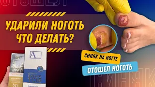 Ударили ноготь, что делать? / Синяк на ногте / Отошел ноготь #ногти #шеллак #подолог #москва