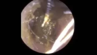 Ear Wax Removal using E-suction® and Crocodile Forceps - Mr Neel Raithatha (THC)