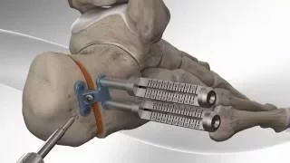 Flatfoot Repair with Arthrex® Calcaneus Step Plate