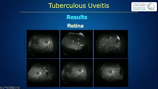 Presumed Tuberculosis Uveitis