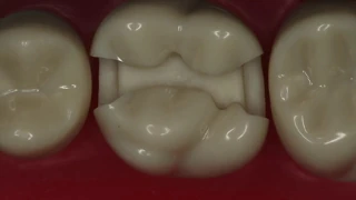 Class II Amalgam Preparation #14 MOD | Amalgam Preparation Technique