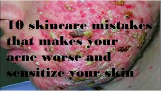 10 skincare mistakes that makes your acne worse