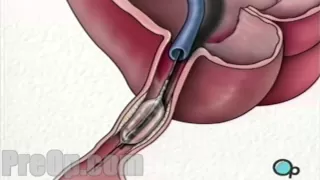 Stent Implantation Coronary Angioplasty - PreOp Patient Education HD