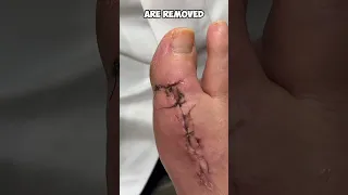 Watch How Easy and Painless Suture Removal Can Be!