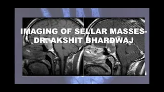 IMAGING OF SELLAR MASSES - PART 1 II DR. AKSHIT II RADIOLOGY LECTURES II NEUROIMAGING