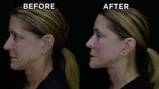 Unbelievable Before and Afters of Neck Lift!