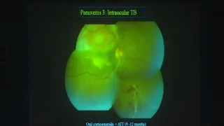 AIOC2019   IC21   Topic   Panuveitis   How long to treat    Dr Reema Bansal