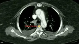 Aortic dissection