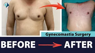 Gynecomastia Before After Instant Result | Gynecomastia Surgery Patient Result After 1 Month