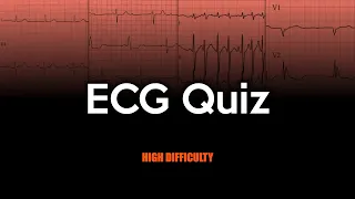 ECG Quiz: High Difficulty