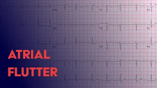 Atrial Flutter -  EKG (ECG) Interpretation