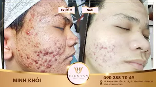 Cách Điều Trị Mụn Viêm, Hiệu Quả Nhất TPHCM Tại Hiền Vân Spa _Minh Khôi I đtrị lần 5 I Bài 356