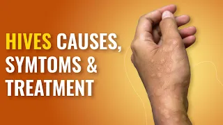 Hives Symptoms | What Causes Hives or Urticaria ? | Hives Treatment | MFine