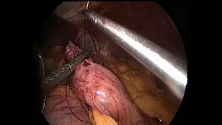 Laparoscopic gastric by-pass Roux en Y