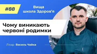 #88 Чому виникають червоні родимки. Спитайте у лікаря Чайки, Вища школа Здоров'я