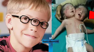 Top 10 Truly Unusual Kids Born With Extra Body Parts You Won't Believe Exist