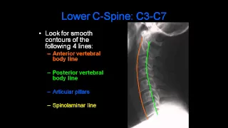 Radiology of Spine Trauma