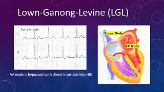 ECG I ACCESSORY PATHWAY I LGL