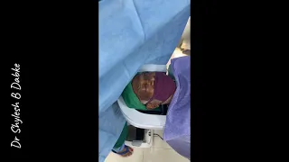 Cataract Surgery - Phacoemulsification - Eyelash Free Draping - Dr Shylesh B Dabke