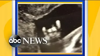 Texas A&M loving parents see rival school symbol in ultrasound