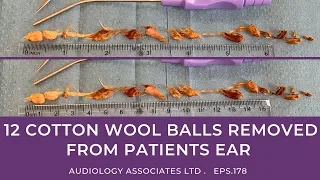 12 COTTON WOOL BALLS REMOVED FROM PATIENTS EARS - EP178