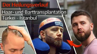 Haar- und Barttransplantation Istanbul - Der Heilungsverlauf | MichaelInDev