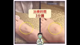 一分鐘診療室: 特別的腱鞘囊腫... (腫塊、筋結、足痛)