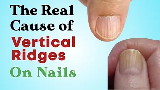 6 Causes Of Vertical Lines On Your Nails | 8 Natural ways to reverse these Ridges | Nourish Nest