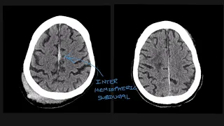 Understanding the different types of traumatic brain bleed on CT scans