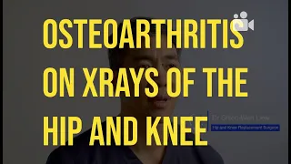 Osteoarthritis on Xrays of Hip and Knee