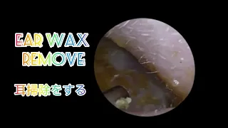 Earwax Cleaning/ Giant Earwax Over 3cm/ How To Clean Your Ears #33