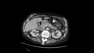 Transverse colon diverticulitis