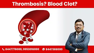 All you need to know about Thrombosis and Blood Clot (100% accurate) | By Dr. Bimal Chhajer | SAAOL