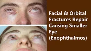 Facial orbital fractures | Enophthalmos Treatment | The Esthetic Clinics, India