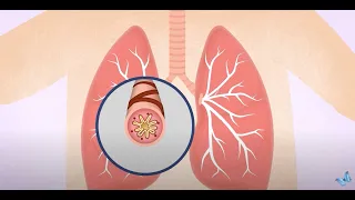 Asthma Triggers in Children