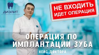 Имплантация Снукон / Имплантация зубов Киров #СтоматологияДиэлит #СтоматологияКиров