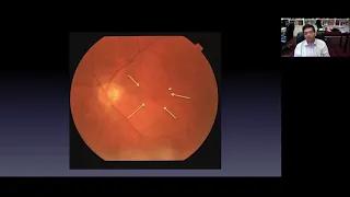 Lecture: Laboratory Work Up of Uveitis Patients & Case Studies